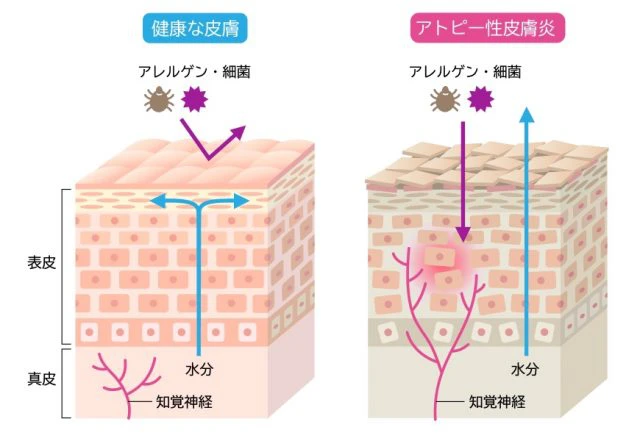 健康な皮膚とアトピー性皮膚炎の皮膚